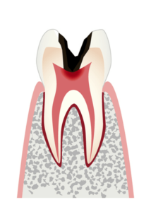 【C3】神経まで進行したむし歯