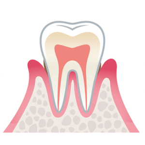 歯周病軽度